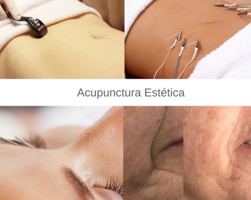 Acupunctura Estética